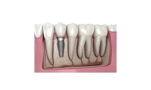 Dental Procedures